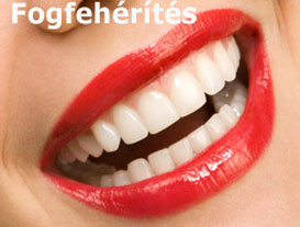 rendelői fogfehérítés